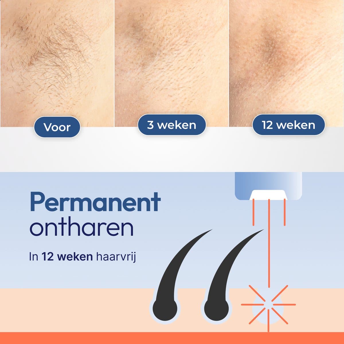 IPL Laser Ontharingsapparaat – Ice Cooling – 999.999+ Flitsen – Epilator Hele Lichaam – 5 Standen – Epileerapparaat Dames – Qualiz® thumbnail 4